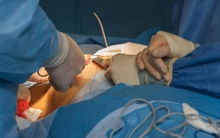 hogyan hajtják végre a mellnagyobbító műtétet