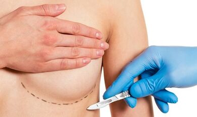 Szubmammarikus hozzáférés az implantátumokkal történő mellbővítéshez