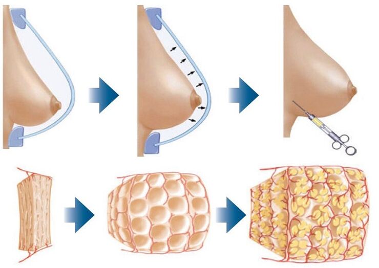 a mellnagyobbítás sebészeti módszere
